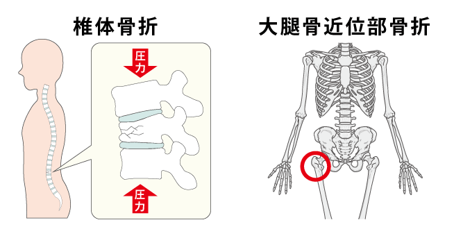 椎体骨折と大腿骨近位部骨折